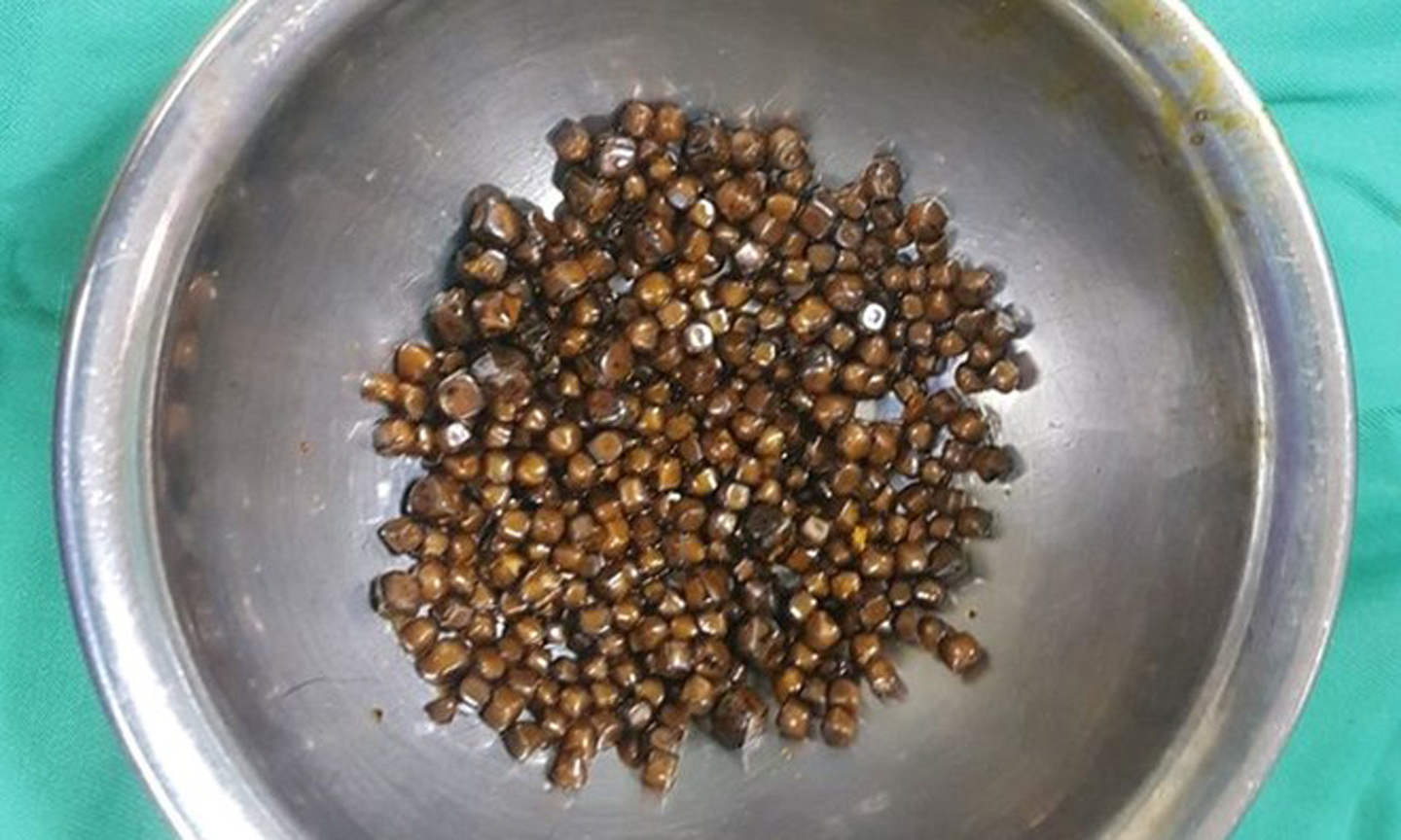 Hàng trăm viên sỏi được lấy ra từ túi mật của bệnh nhân. (Ảnh: PV/Vietnam+)