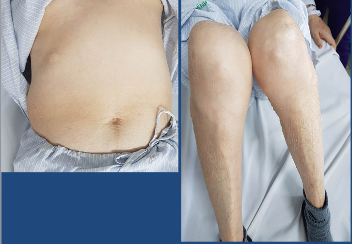 Bệnh nhân có biểu hiện kiểu hình Cushing.