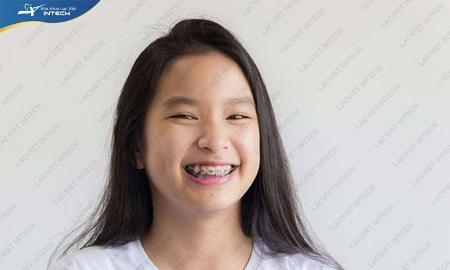 Kết quả chỉnh nha (niềng răng) đạt được sau khi hoàn thành xong.