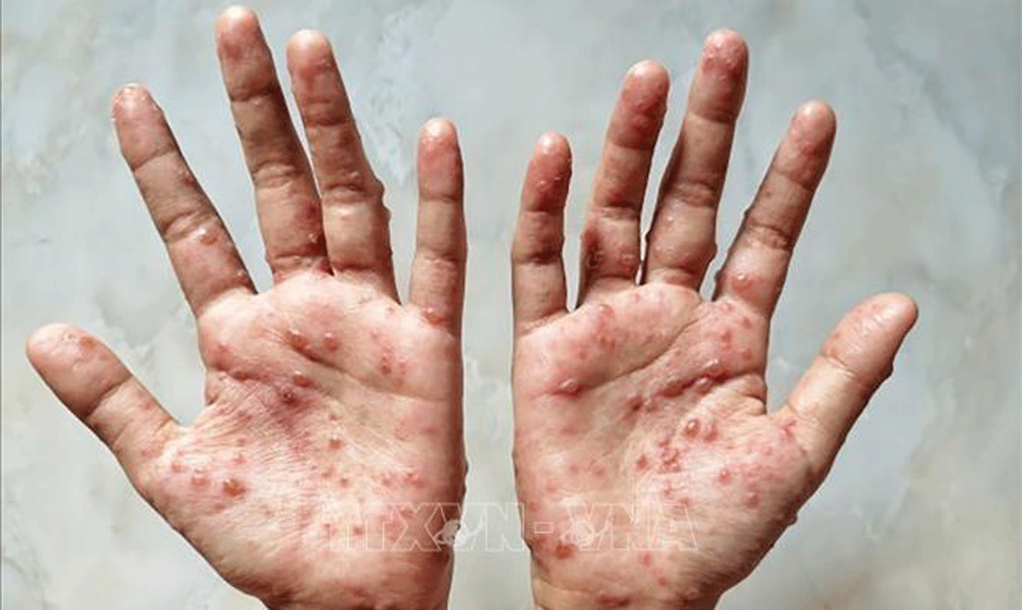 Các ban đỏ nổi trên tay một bệnh nhân mắc đậu mùa khỉ. Ảnh: Shutterstock/TTXVN