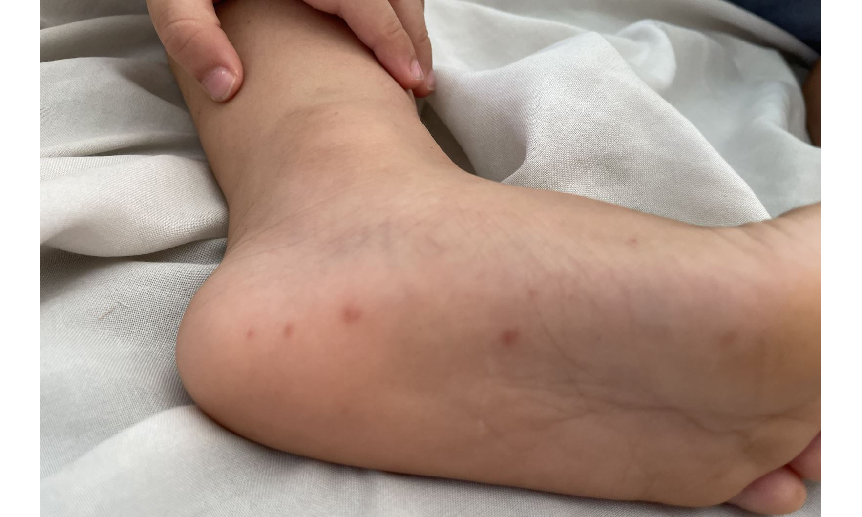 Trẻ bị tay chân miệng thường xuất hiện các nốt hồng ban ở lòng bàn chân, tay.