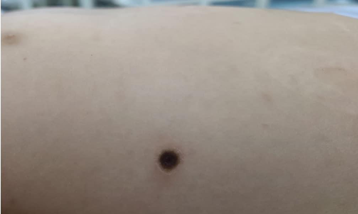 Nốt mò đốt trên bệnh nhi. Ảnh: BV