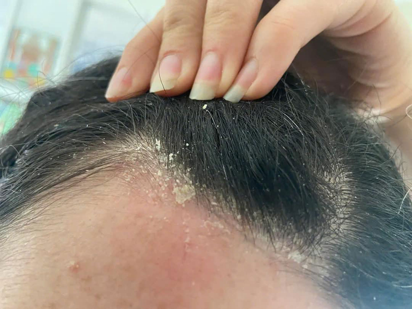 Gàu khiến da đầu ngứa ngáy, gây mất thẩm mỹ ở phái đẹp.