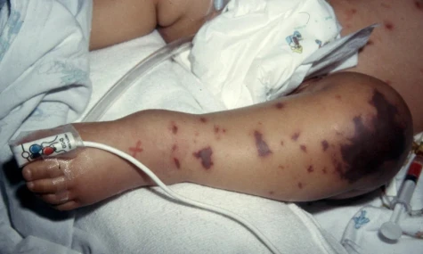 Ca mắc não mô cầu gia tăng: Căn bệnh có thể khiến người bệnh tử vong trong 24 giờ