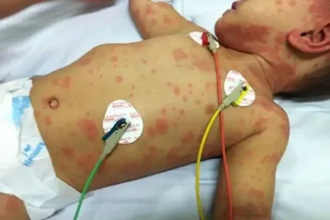 Bệnh viêm não mô cầu gia tăng: giám sát chặt chẽ, hạn chế lây lan