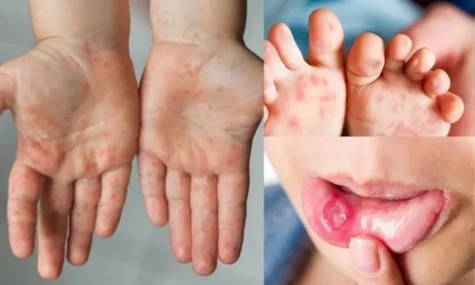 Bộ Y tế hỏa tốc yêu cầu ngăn chặn EV71 và dịch tay chân miệng bùng phát